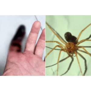 Garçom com a mão enfaixada após ser picado por uma aranha, destacando os riscos associados a acidentes com aracnídeos